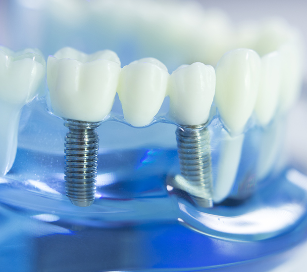 Anchorage Dental Implants