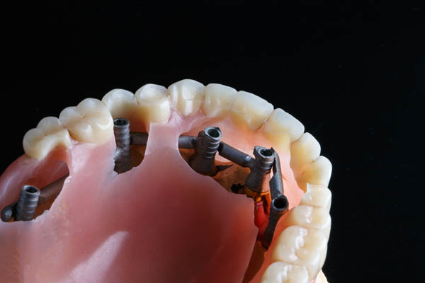 Implant Supported Dentures Anchorage, AK